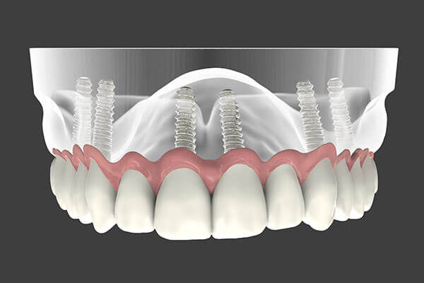 Implant Supported Dentures in Port Washington