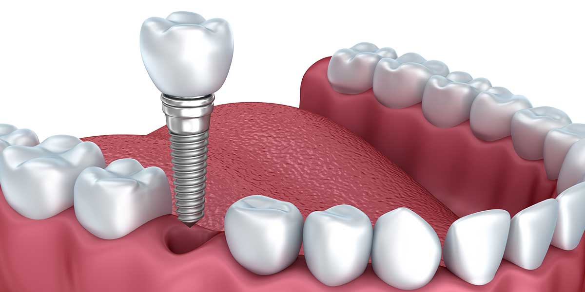 Single Dental Implants in Port Washington