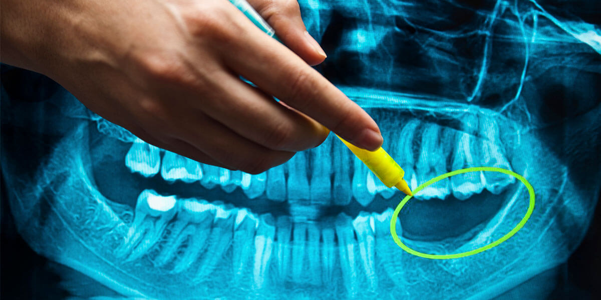 Benefits of Dental Implants in Port Washington