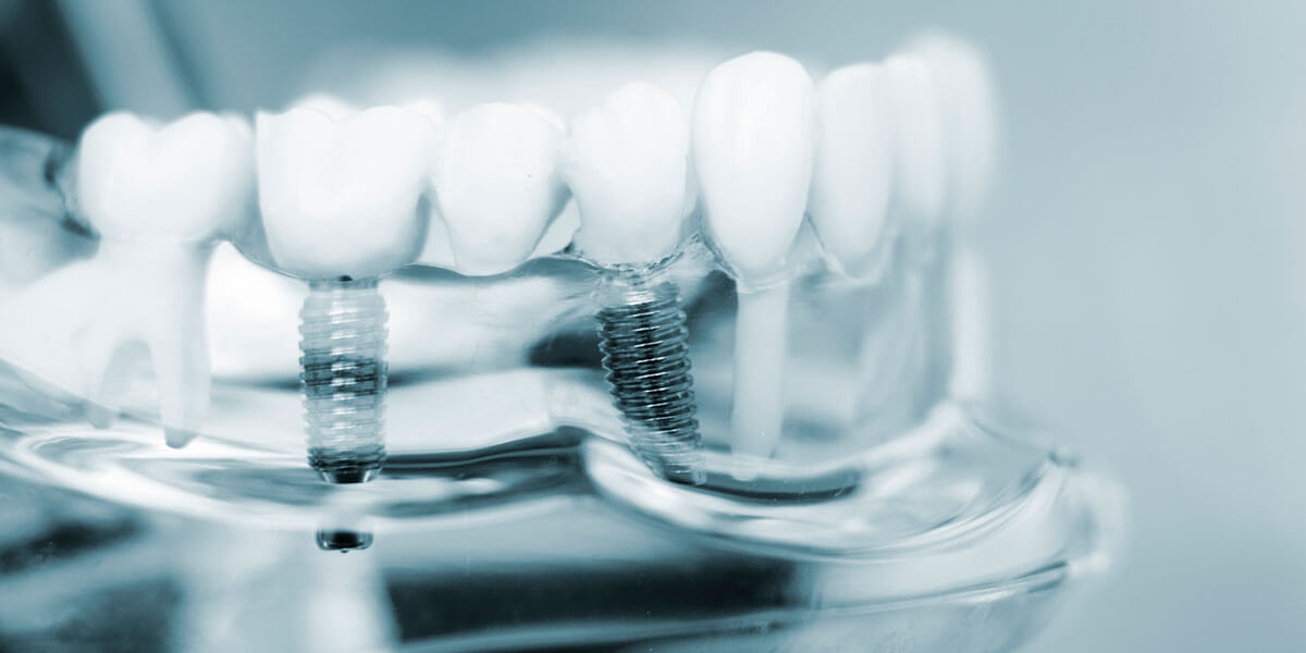 Dental Implants in Port Washington