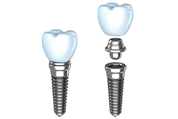 Single Dental Implants in Port Washington