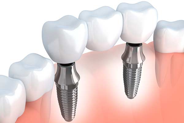 Implant Supported Bridges in Port Washington