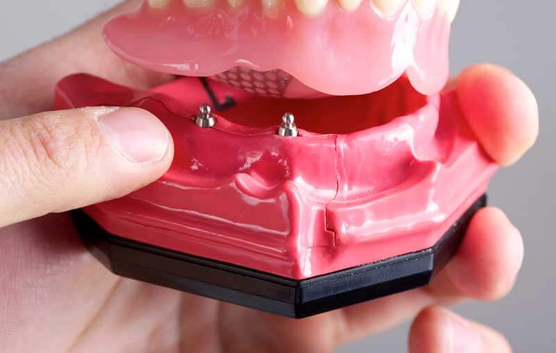 Mini Dental Implants in Port Washington