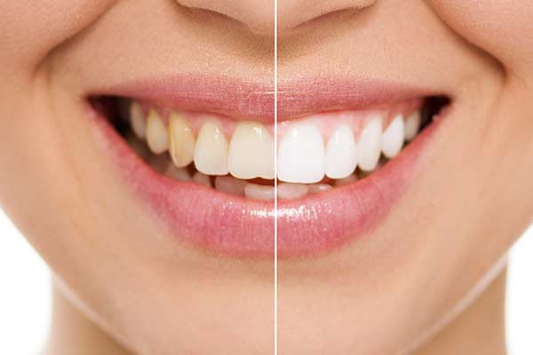 Teeth Whitening in Port Washington