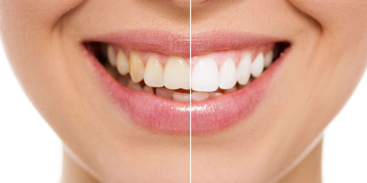 Before & After Teeth Whitening in Port Washington